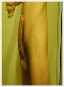 Gay 包皮, 非常瘦小